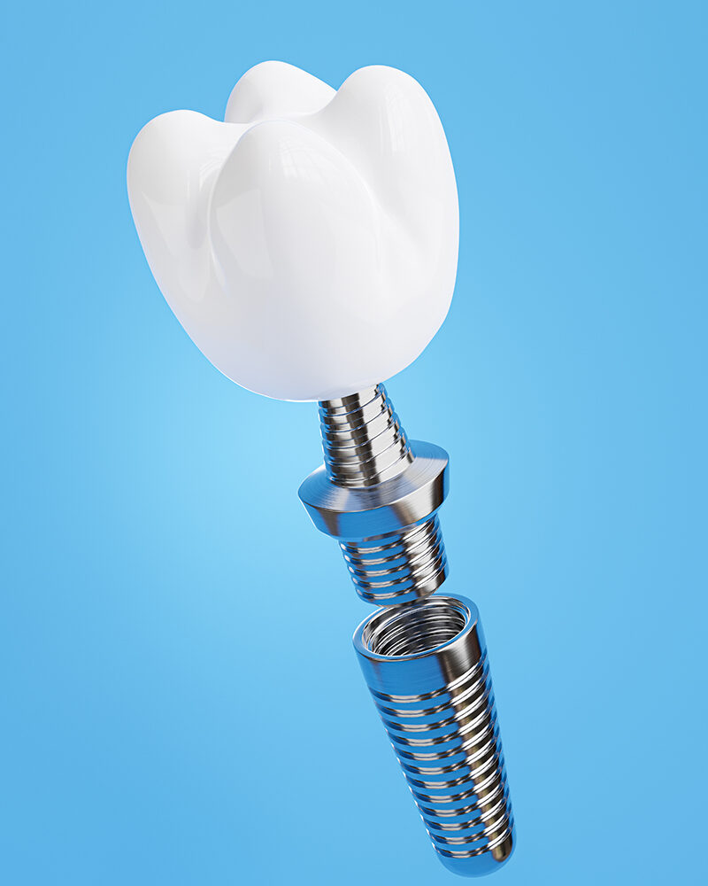 Implant dentar dinte Implant Renew Dental Office dr. Lisa Brădățanu Jebel Header